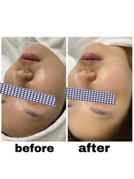 エクスクラメーションマーク(!!!)/ララピール