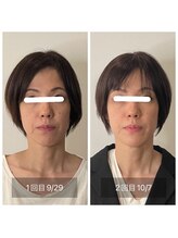 アウル なかもず店(OWL)/肌質改善ビフォーアフター