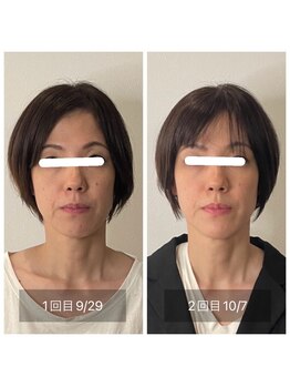 アウル なかもず店(OWL)/肌質改善ビフォーアフター