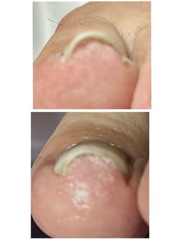 ラヴィ(La vie)/巻き爪で時々痛み