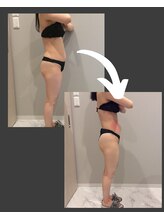 トラレス(Trouless)/脂肪冷却