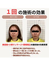 クローバー鍼灸整骨院/小顔マッサージ+美容鍼+頸椎矯正