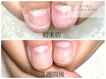 グレースレディ 大阪店/(深爪/長さだし/フィルイン)