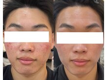 ニキビやざらつきなど肌悩みに寄り添うフェイシャルケア。