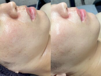 エモーショナル 姫路(Emotional)/乾燥・くすみ・毛穴の開き改善