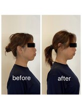 リバイブ 五反田店(REVIVE)/小顔矯正1回