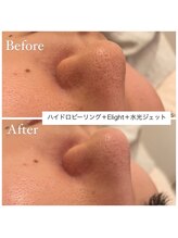 【10年先も続く美しさへ】Maison Ruban 天王寺店｜ニキビ・毛穴・小顔・たるみ/毛穴洗浄・美白フォト毛穴ケア