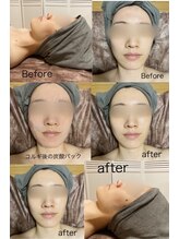 ネリネ(Nerine)/【小顔/乾燥肌/艶肌】炭酸パック