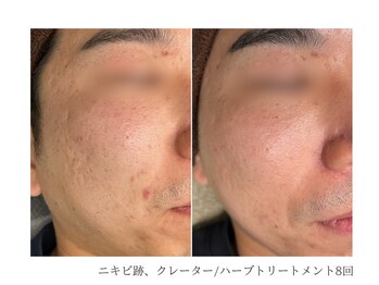 ルーム(room)/ハーブトリートメント8回