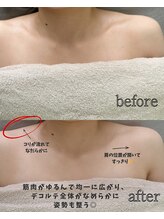 メルーラ(Mellura)/デコルテ、before/after