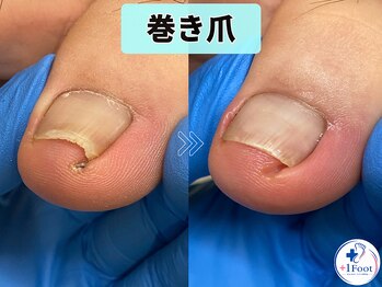 プラスワンフット 本厚木(+1 Foot)/巻き爪の痛みと爪切りの切り残し