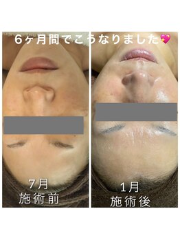 ヴィオナス(Veonus)/6ヶ月でこうなりました。