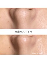 ルルアス 銀座(LuLuAS)/黒ずんだ毛穴にアプローチ♪