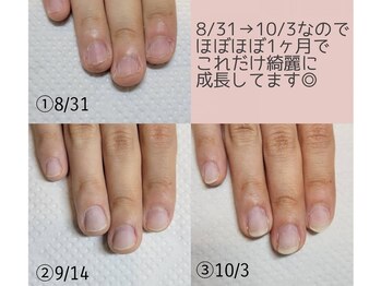 プリンセスネイル(Princess nail)/深爪矯正