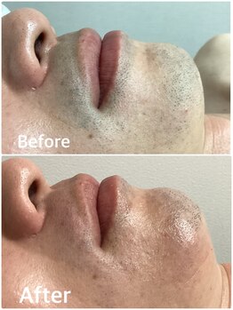 プルーラントエステ キョウト ビジョーラ(PullulantEsthe Kyoto×BEJORA)/メンズ髭脱毛