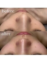 エクリア(ECLIA)/プラピール+毛穴洗浄