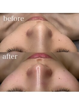 エクリア(ECLIA)/プラピール+毛穴洗浄