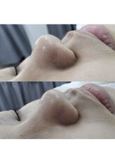 エムズビューティスタジオ エステ リラク 西川口店(M's Beauty Studio)/黒ずみ徐去