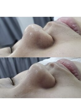 エムズビューティスタジオ エステ リラク 西川口店(M's Beauty Studio)/黒ずみ徐去