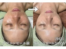 ルーチェ(LUCE)/グリーンピール5DAYS