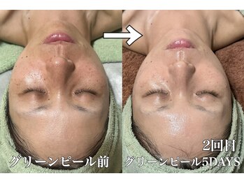 ルーチェ(LUCE)/グリーンピール5DAYS