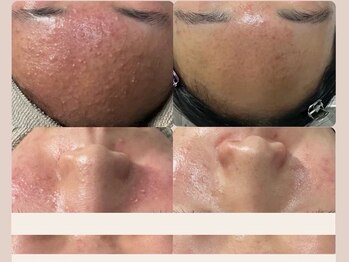 ウール(Heure.)/ハーバルピーリング