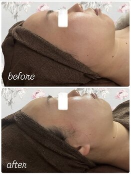 イロドリ(IRODORI)/REVIハーブピーリング