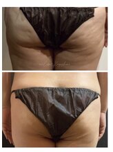 ミーラブ 鹿児島(miilove)/小尻＆頑固な凹凸セルケア