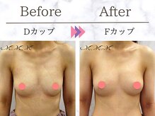 メディカルサロン エム エム エム 心斎橋本店(M.M.M)/【バストアップ例】　D→Fカップ