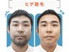 毎朝のヒゲ剃りを楽に★ヒゲ脱毛集中体験プラン