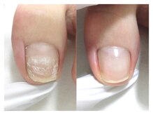 巻き爪ケアサポート ルアナ(LUANA)/Before→After