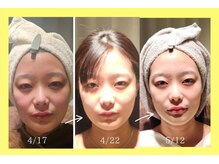 アン 銀座(ann)/レモンボトル3回