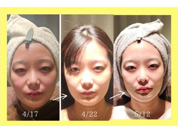 アン 銀座(ann)/レモンボトル3回