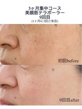 ソルテシュガーリング(SORTE sugaring)/テラボーラー3ヶ月集中コース