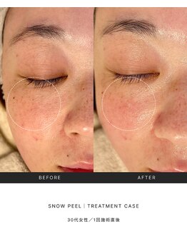 スキンラウンジ(SKIN LOUNGE)/韓国肌管理｜PDRN雪花ピール