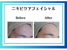 リヴェーヌ 富山店/にきび改善はリヴェーヌ富山店で