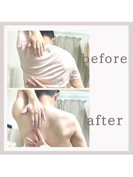 アリサナ(Arisana)/症例写真　肩甲骨はがし