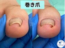 プラスワンフット 本厚木(+1 Foot)/巻き爪の痛みと爪切りの切り残し