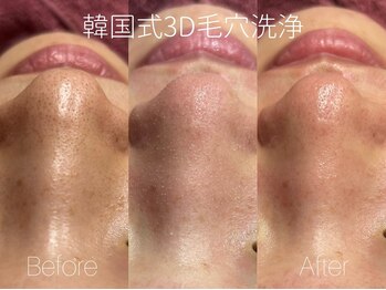 ビヨンド リンク(BEYOND L'INK)/韓国式3D毛穴洗浄