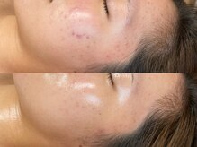 ビジュープラス 広島店(Bijou+)/【20代/ニキビ肌】