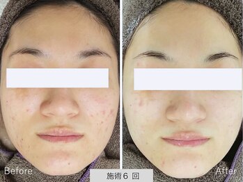 ニキビ研究所 千葉店/毛穴から変わる！ハリツヤ肌へ！