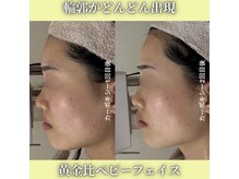 ハニエル(Haniel)/カーボキシー症例