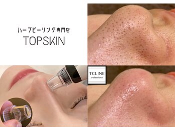 トップスキン 名駅(TOPSKIN)の写真/STAFFイチ推し！【ハーブピーリング×毛穴洗浄の最強タッグ】黒ずみ毛穴/開き/ガンコ毛穴タイプも改善☆
