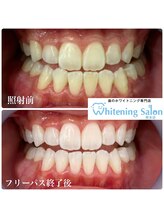 ホワイトニングサロン 熊本店/【ホワイトニング施術例】