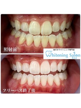 ホワイトニングサロン 熊本店/【ホワイトニング施術例】