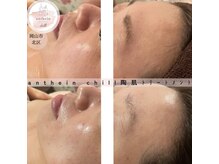 アンテイン チル(anthein chill)/陶肌トリートメント