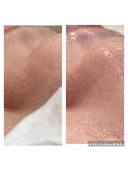 ルナート(Lunart)/毛穴洗浄/毛穴ケア