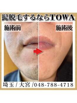 トワ 大宮(TOWA)/~脱毛・症例写真~