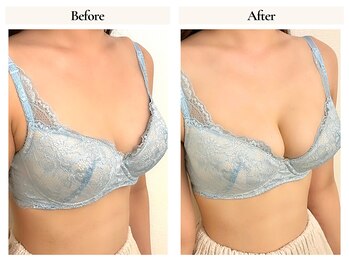 サロンドローヴ(Salon de LOAVE)/バストアップ症例