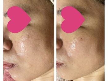 紫檀(シタン)/艶肌フェイシャル